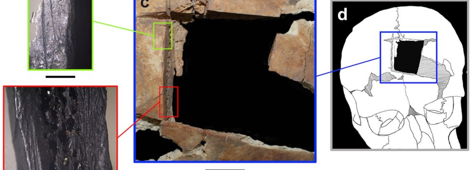 Ο άνθρωπος με μια τετράγωνη τρύπα στο κρανίο του: Ένδειξη για χειρουργική εγκεφάλου πριν 3.500 χρόνια στο Ισραήλ
